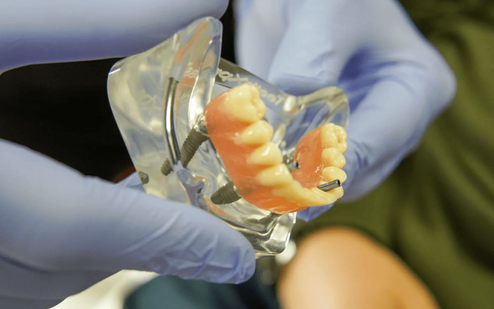 Complete smile restoration complete dental implants