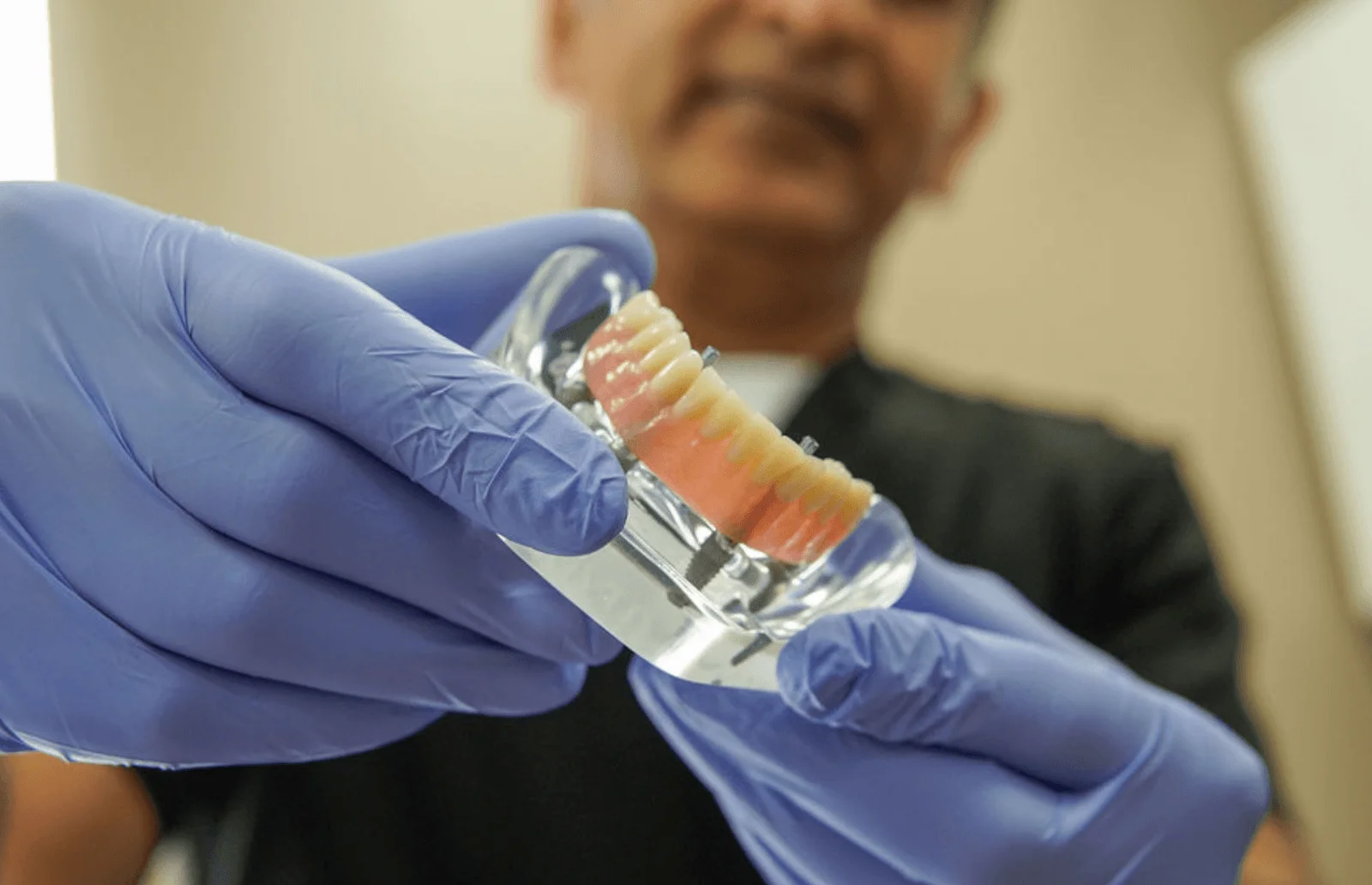 Implant supported denture complete dental implants