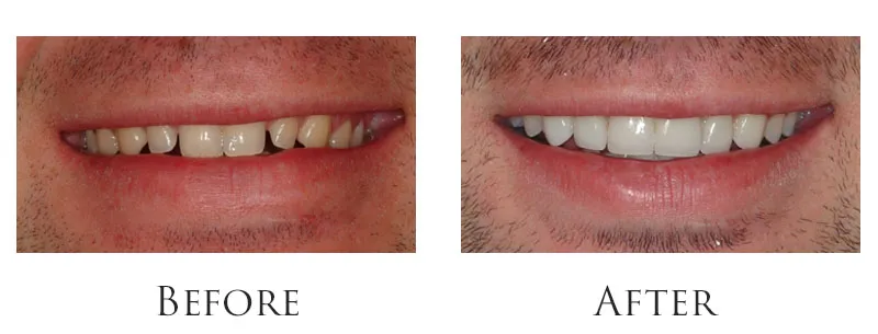 Dr. Reese Smile Makeover Indianapolis