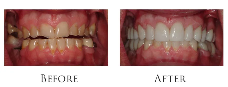 Dr. Reese Smile Makeover Indianapolis