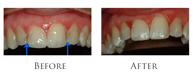 dr-reese-fillings replace
