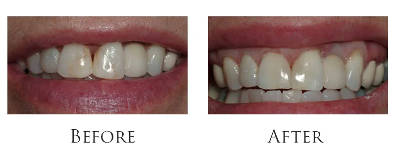 Old Fillings Replaced to Match Shade