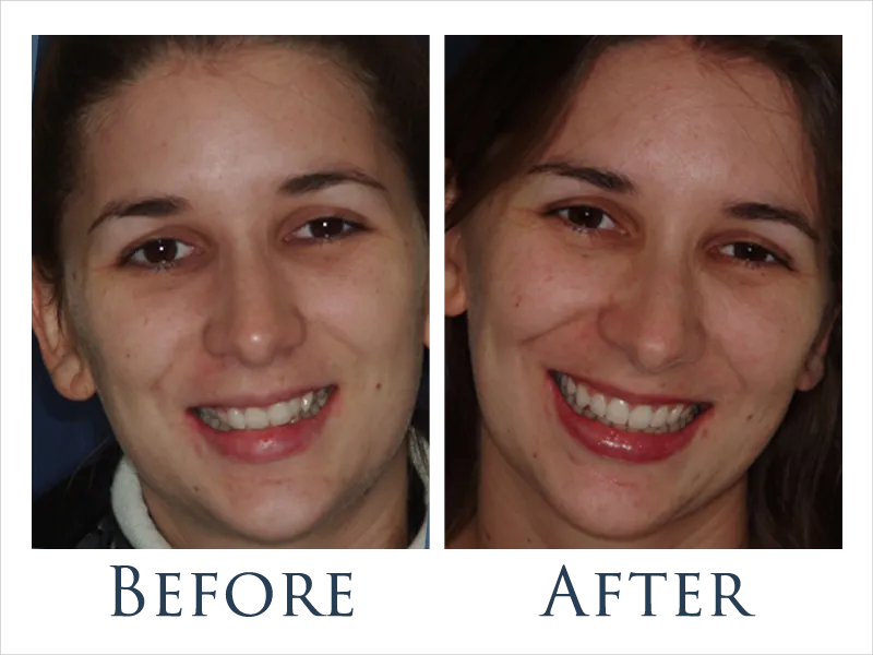 Before and After Braces