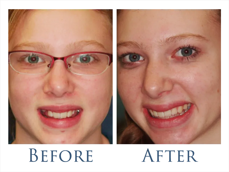 Before and After Braces