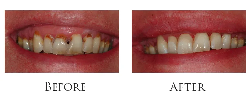 Extensive Cavity Damage Restored Same-Day