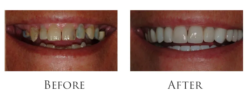 Dr. Reese Smile Makeover Indianapolis