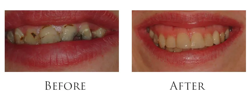 Extensive Cavity Damage Restored Same-Day