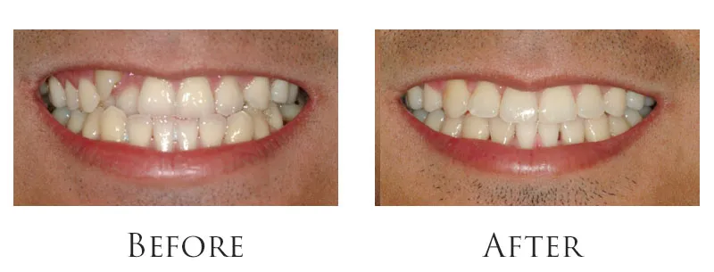 Dr. Reese Smile Makeover Indianapolis