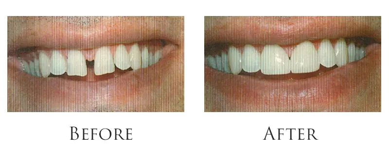 Dr. Reese Smile Makeover Indianapolis