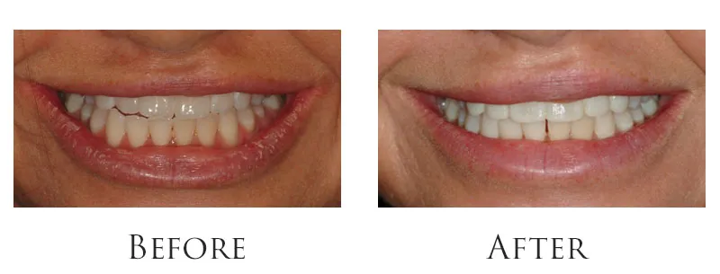 Dr. Reese Smile Makeover Indianapolis