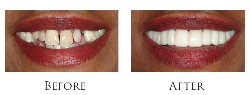 Sna-on smile - Snap-On Smile is a Pain-Free Smile Makeover