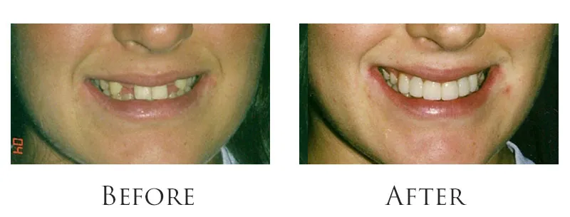 Bonded bridges - Missing teeth: before and after