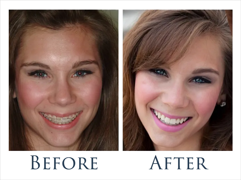 Before and After Ceramic Braces