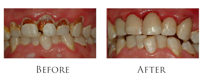 Extensive Cavity Damage Restored Same-Day
