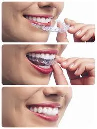 Invisalign Clear Aligners - Orthodontics in Indianapolis IN