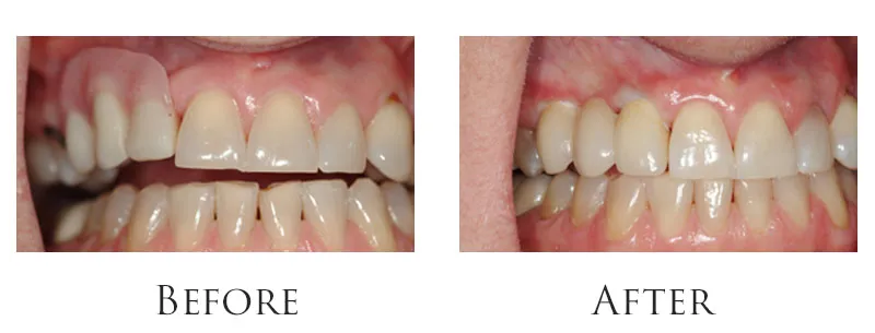 Dental Implant: before and after