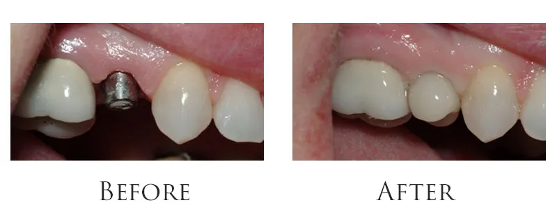 Single tooth replacement with an implant.