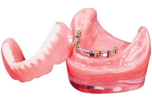 Lower Implant Overdenture