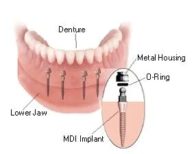 Dentures in Indianapolis IN