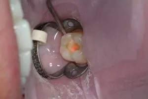 Laser Treatment of Tooth to Remove Decay