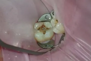 Decay Under Old Mercury Filling