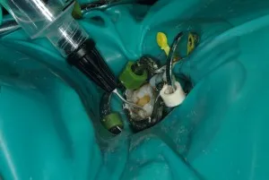 Amalgam Removal