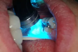Amalgam Removal