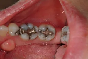 Amalgam Removal