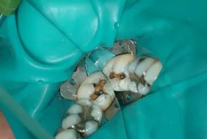 Amalgam Removal