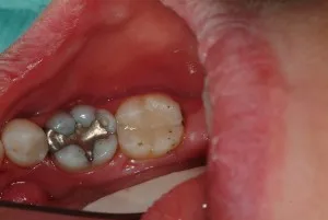 Amalgam Removal