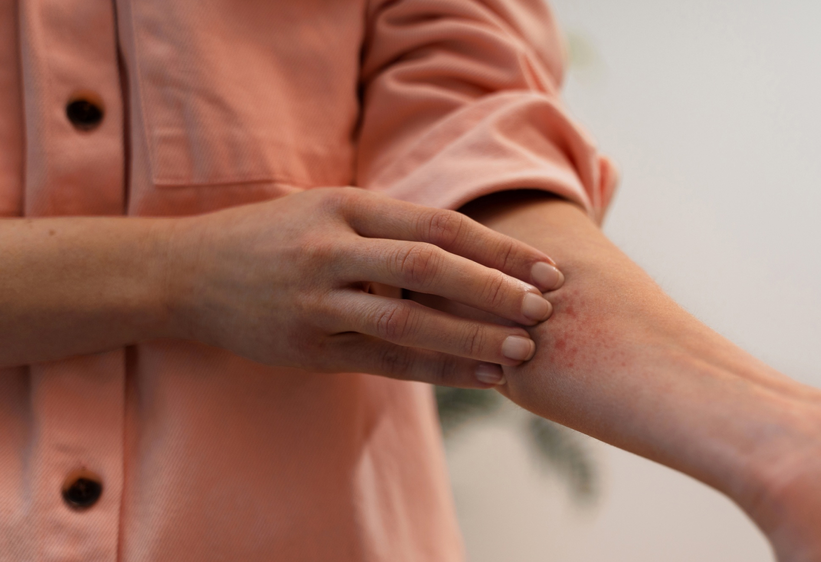 ¿Cómo saber si tengo Herpes Zóster? Síntomas clave y fases iniciales