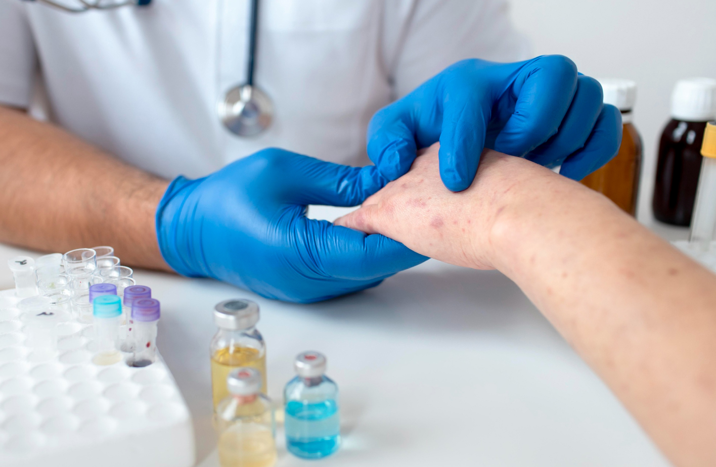 ¿El Herpes Zóster es contagioso de persona a persona? Mitos y verdades