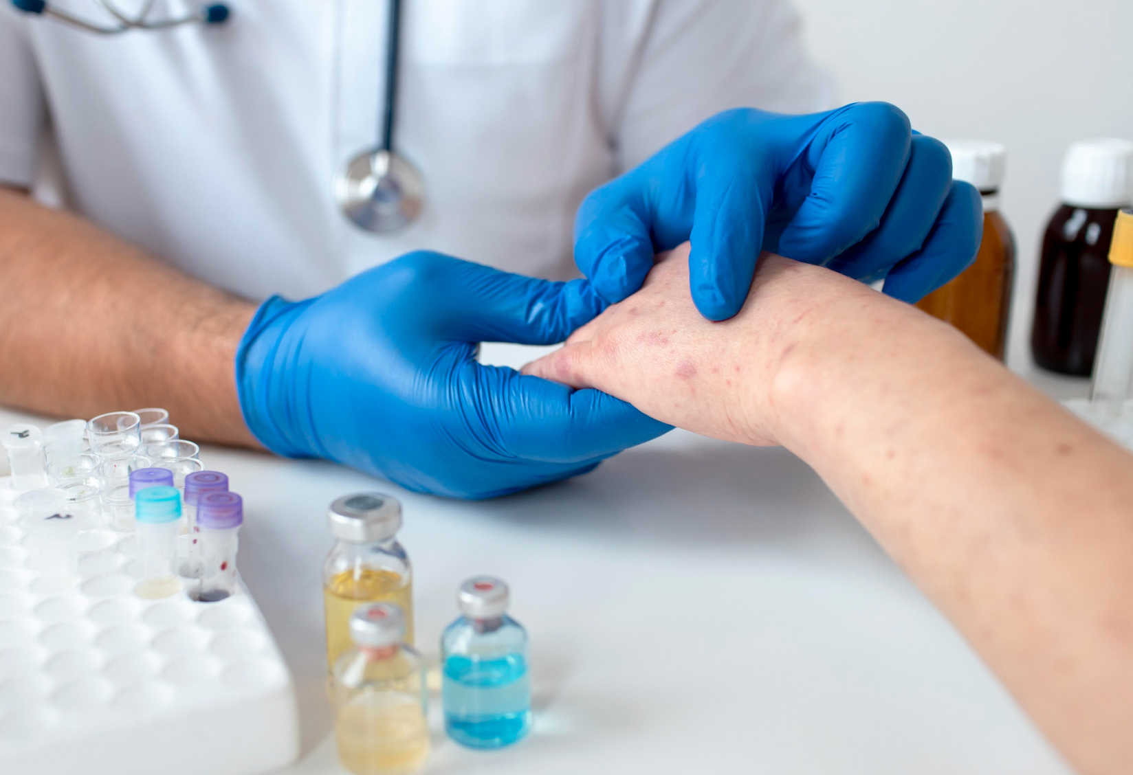 ¿El Herpes Zóster es contagioso de persona a persona? Mitos y verdades