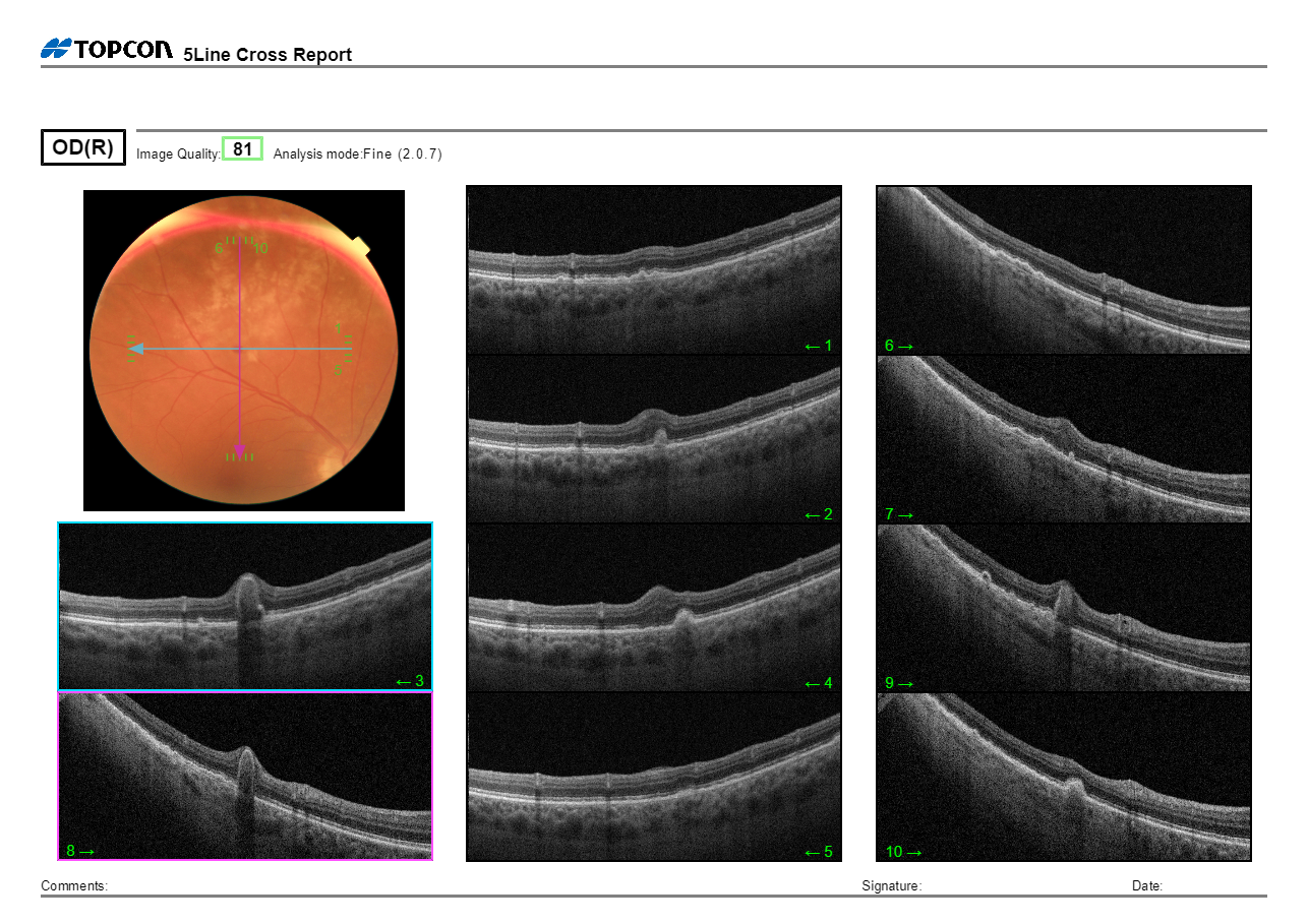 Care1 blog: Peripheral CNVM in 60 YO Female with Drusen and Retinal Hemorrhage