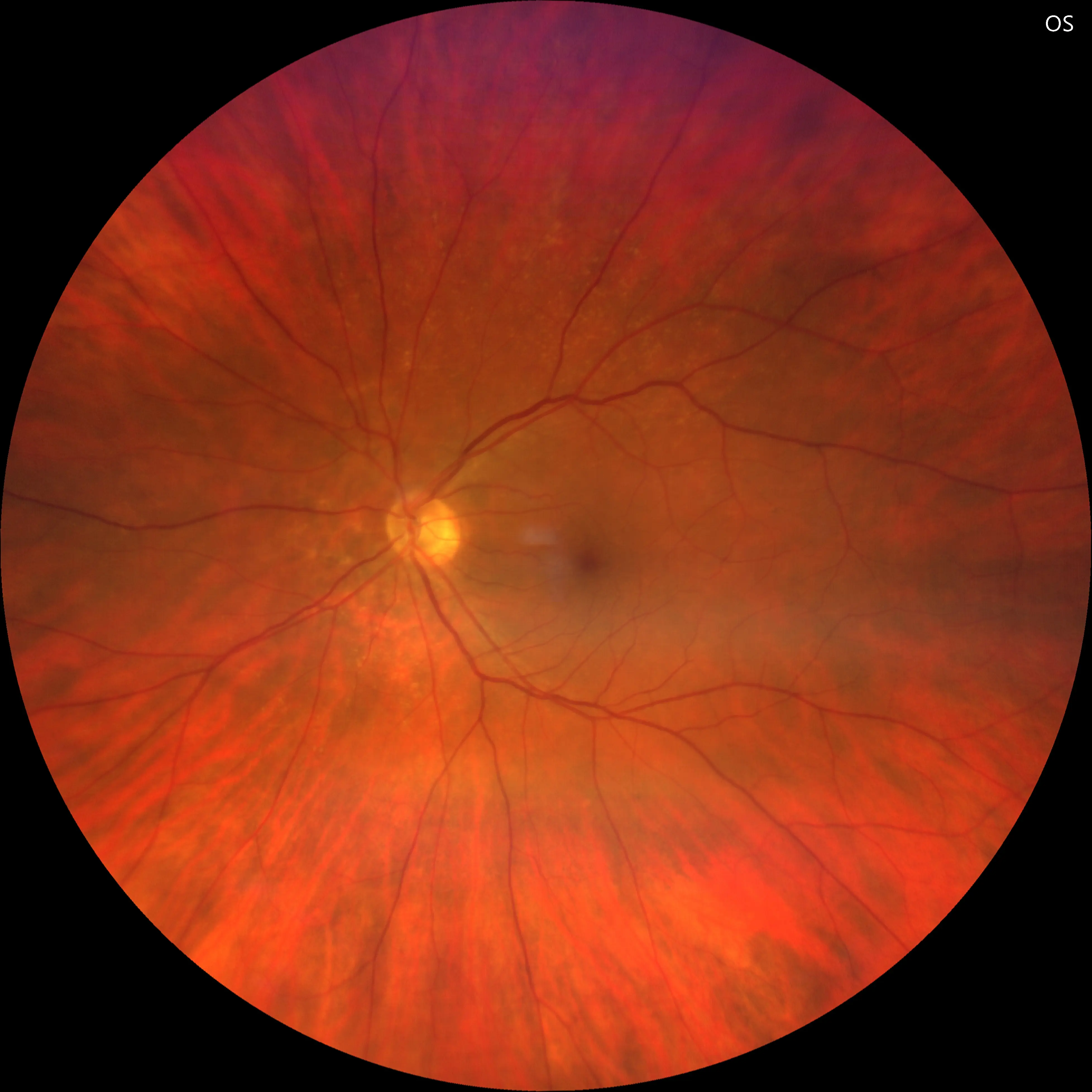 Care1 blog: Peripheral CNVM in 60 YO Female with Drusen and Retinal Hemorrhage