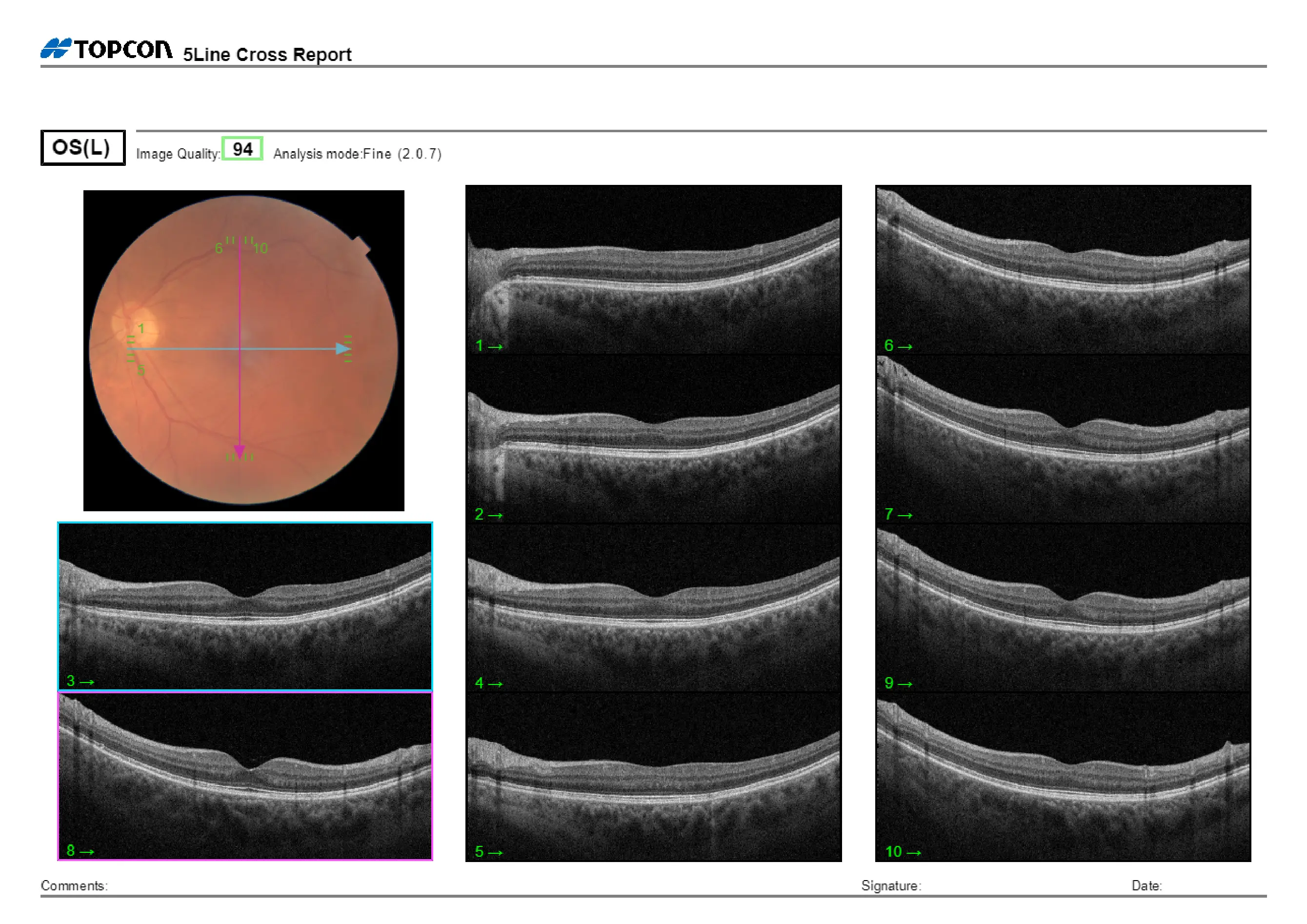 Care1 blog: Peripheral CNVM in 60 YO Female with Drusen and Retinal Hemorrhage