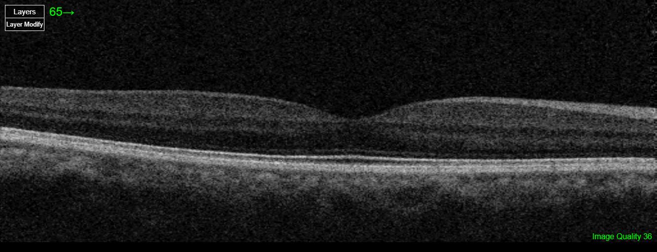 Care1 blog: Patient With Past Retinal Fluid, Normal Vision Today
