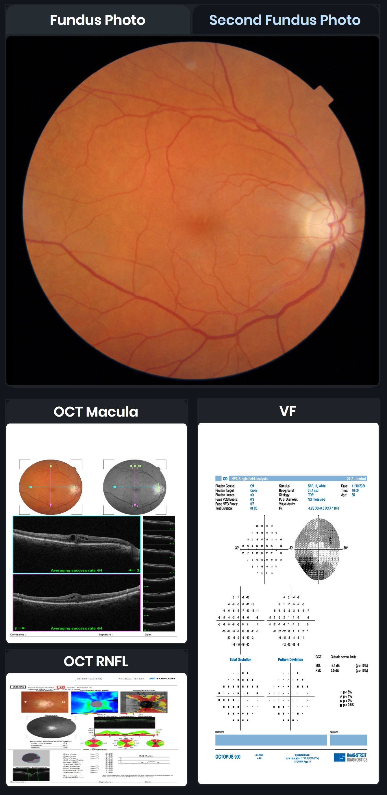 Care1 blog: Bilateral Macular Edema