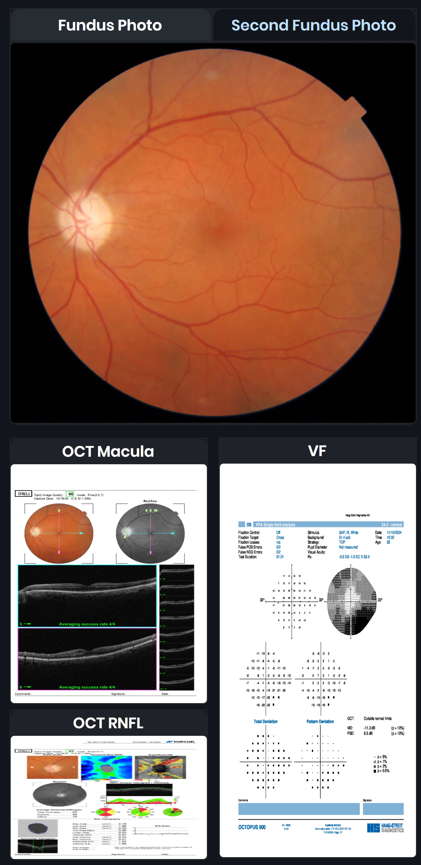 Care1 blog: Bilateral Macular Edema