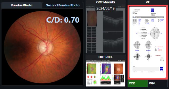 Bilateral Macular Edema
