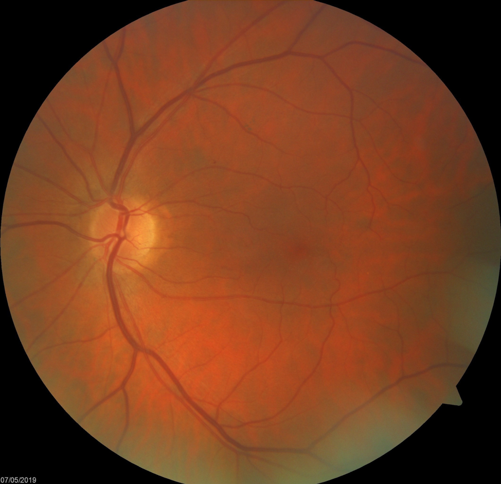 Care1 blog: Redefining Retinal Risk Detection: Using AI to Quantify Vascular Tortuosity