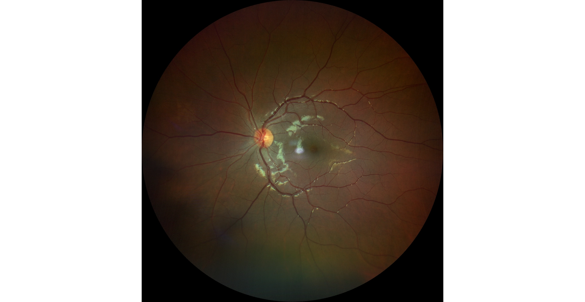 Care1 blog: Rare Pediatric Case: Optic Nerve Pit