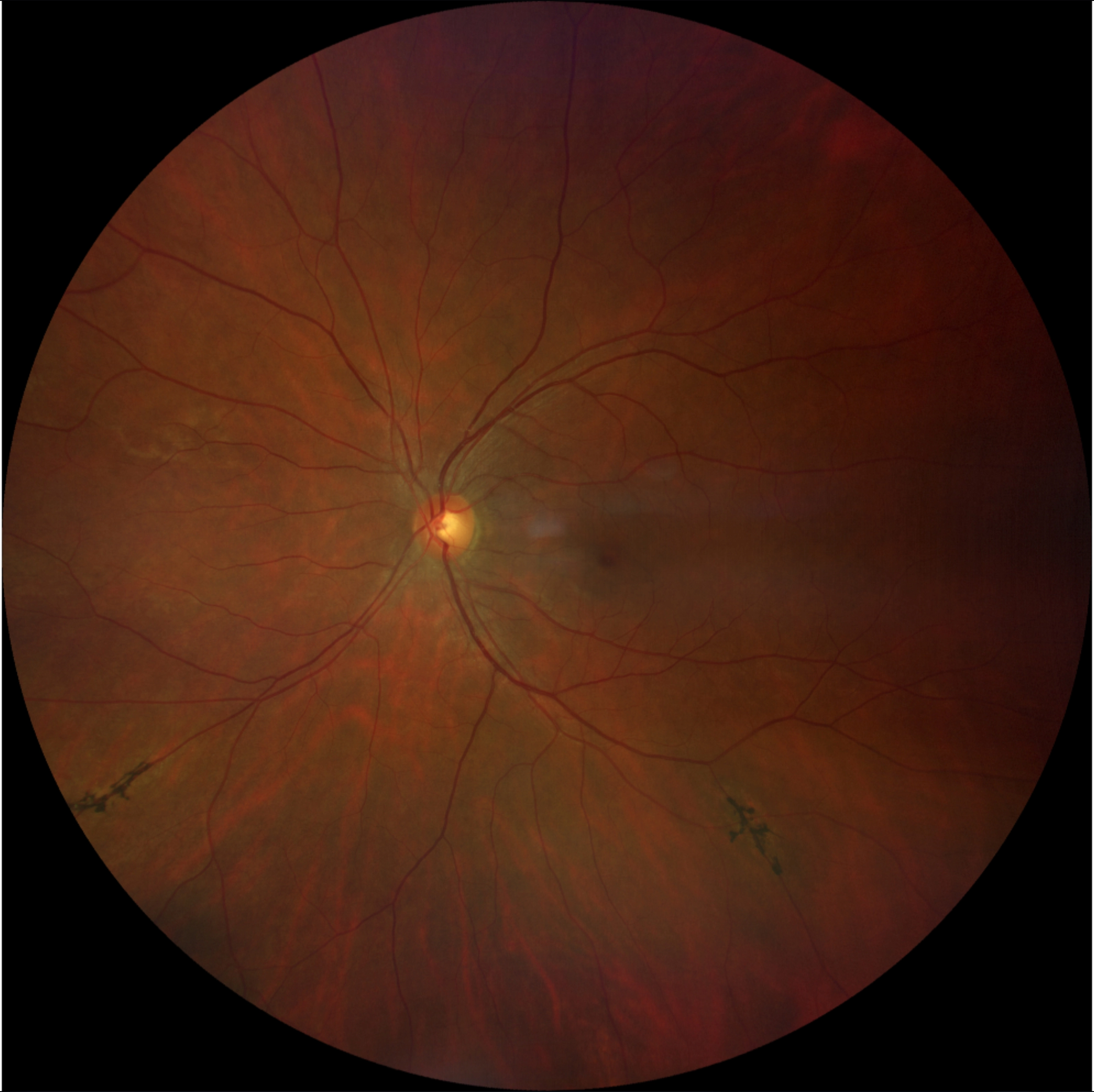 Care1 blog: Pigmented Paravenous Retinochoroidal Atrophy (PPRCA)