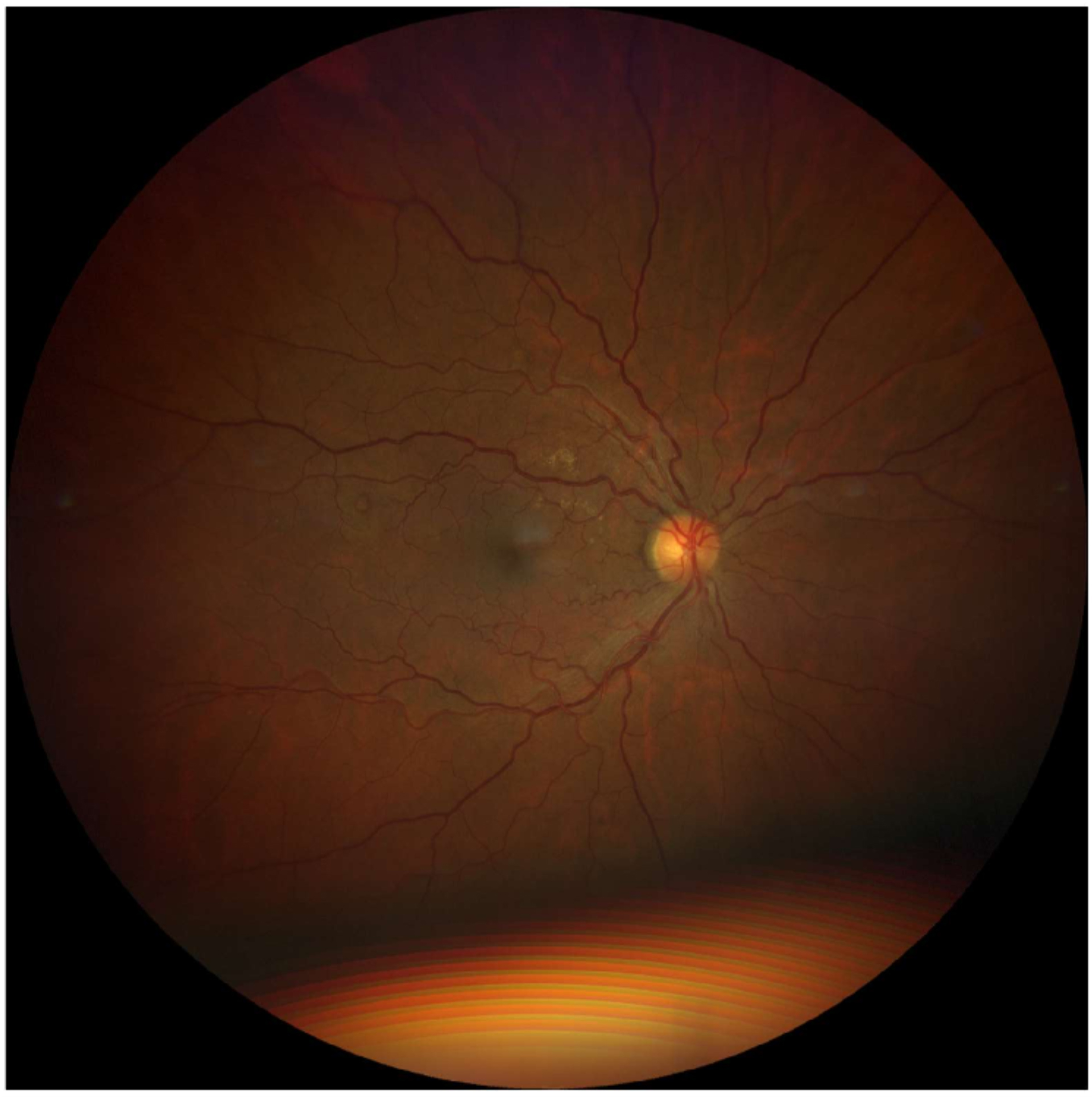 Care1 blog: Atrophic Scar from Resolved Choroidal Neovascularization (CNV)