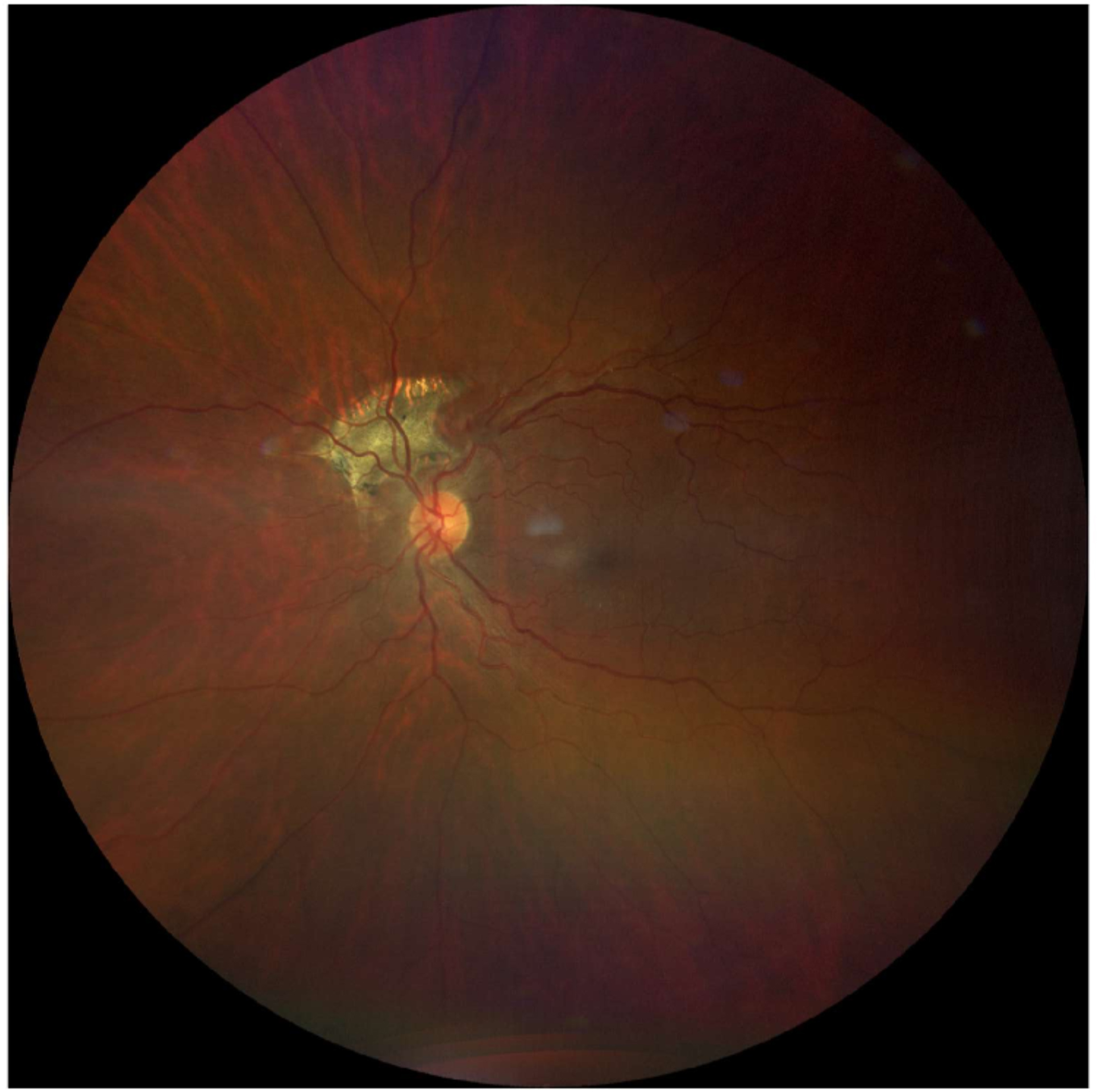 Care1 blog: Atrophic Scar from Resolved Choroidal Neovascularization (CNV)