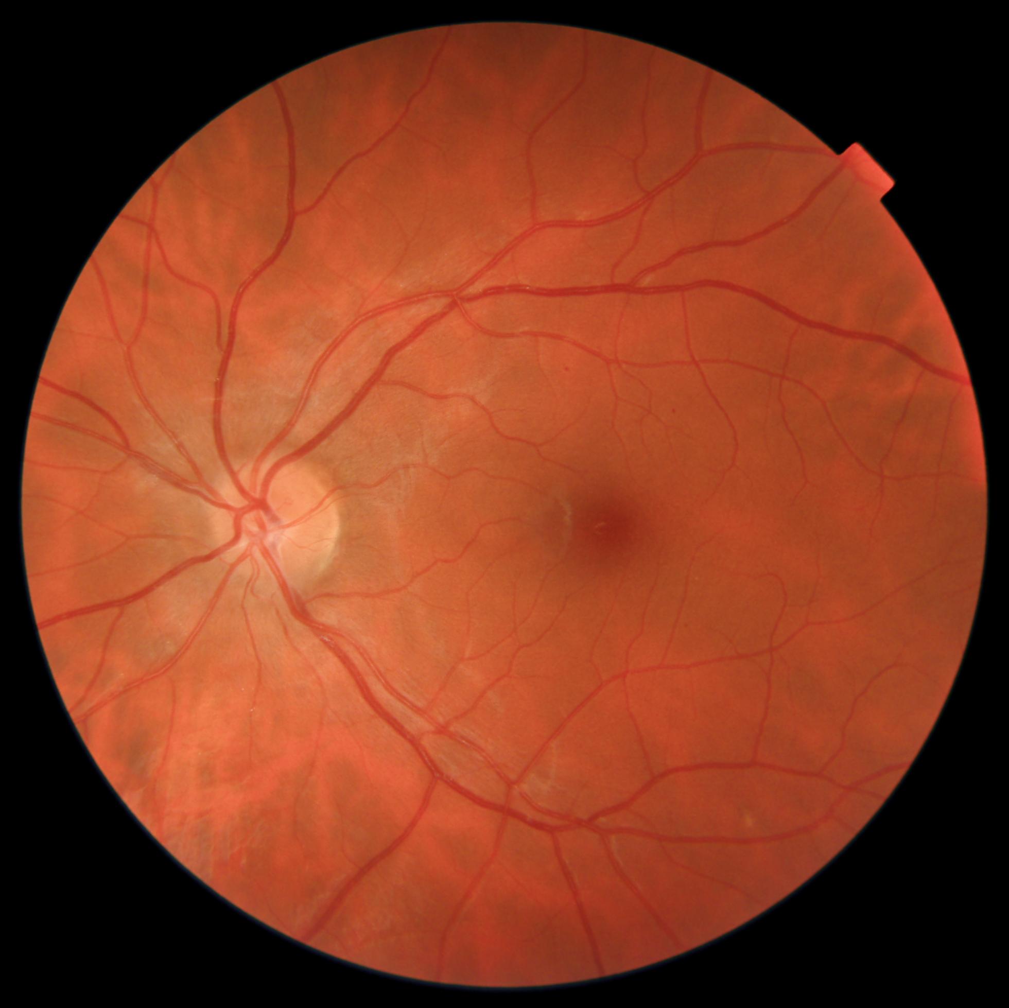 Care1 blog: Trauma-Linked Flashes