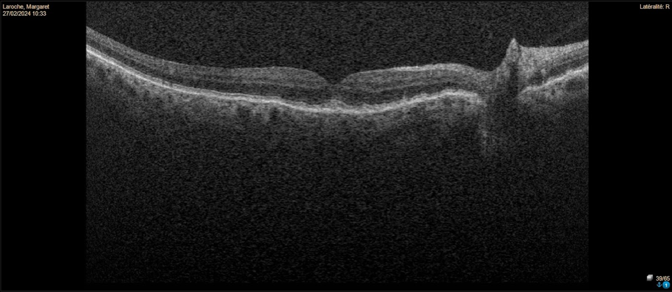 Care1 blog: Vision Changes Near the Optic Nerve