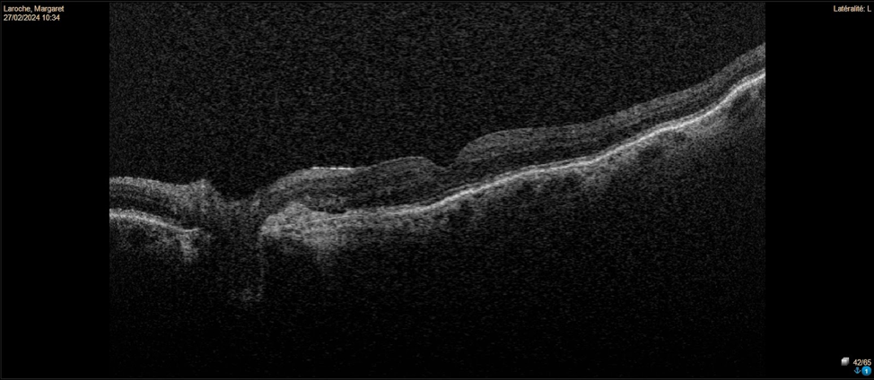 Care1 blog: Vision Changes Near the Optic Nerve