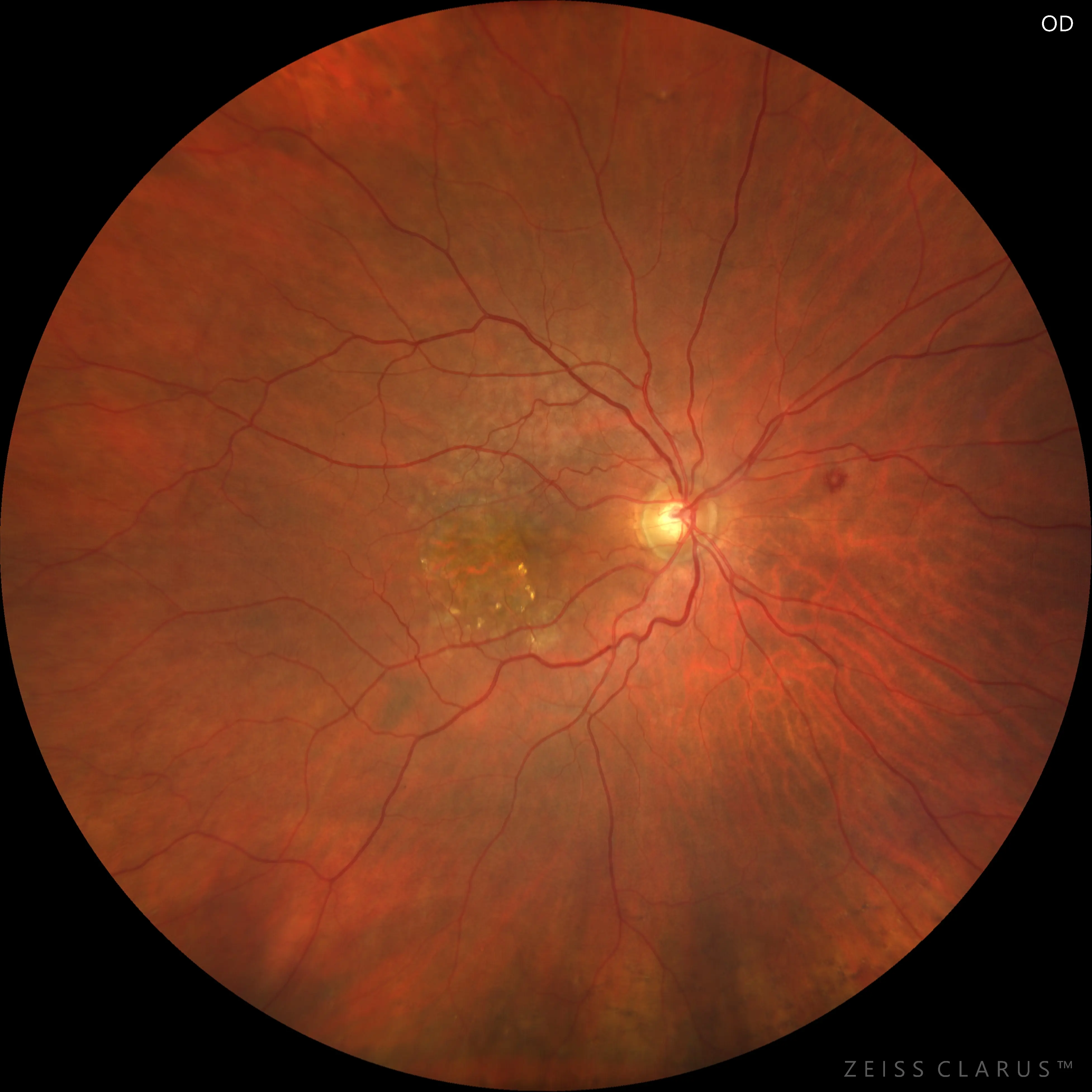 Fundus photo of the patient’s right eye showing macular fibrotic scarring