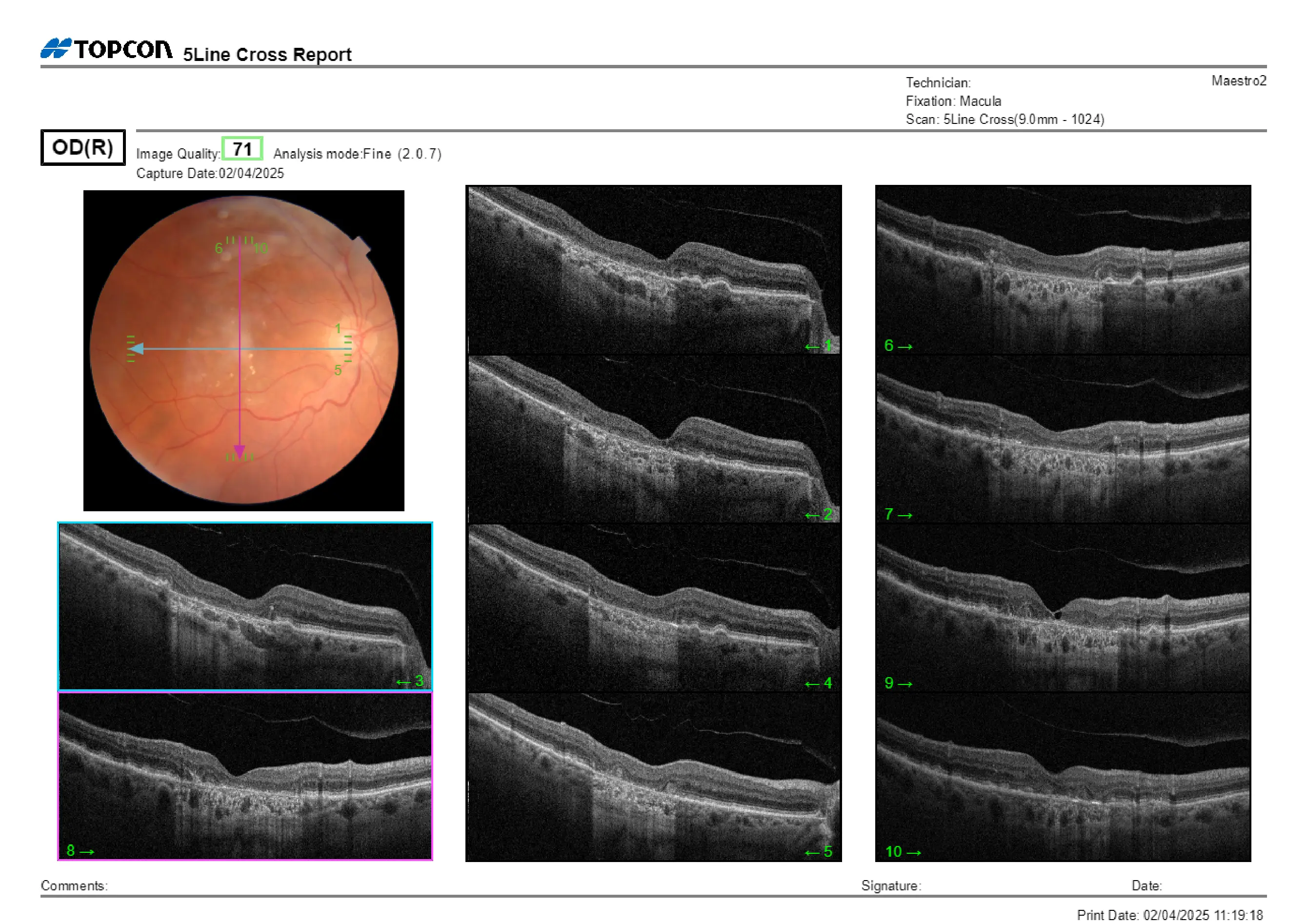 Monitoring Advanced Macular Changes in an 85-Year-Old Patient